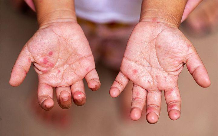 Hướng Dẫn Phòng Chống Bệnh Tay Chân Miệng Hiệu Quả cho Phụ Huynh