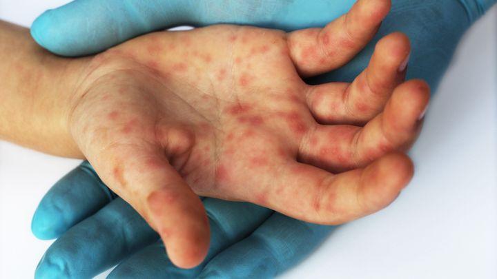 Các Biến Chứng Nguy Hiểm của Bệnh Tay Chân Miệng và Khi Nào Cần Đưa Trẻ Đến Bệnh Viện